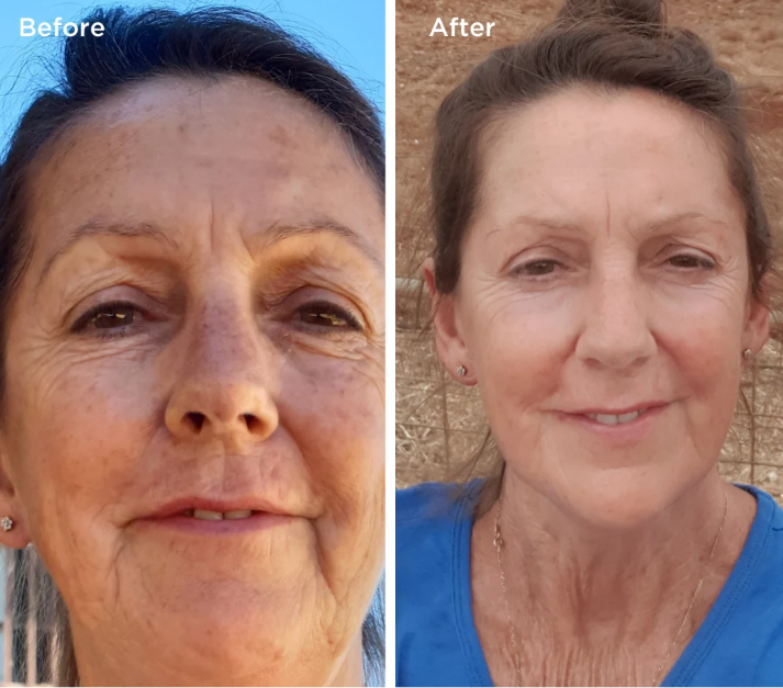 Laura risultati Eslow Skin pelle luminosa